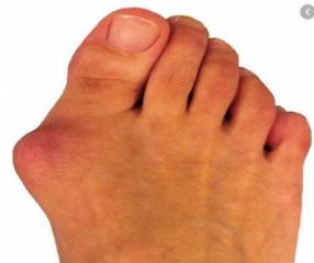 چگونه از انحراف انگشت شست پا جلوگیری كنیم؟